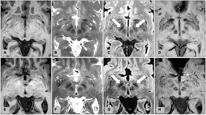 Quantitative Analysis for the Delineation of the Subthalamic Nuclei on Three-Dimensional Stereotactic MRI Before Deep Brain Stimulation Surgery for Medication-Refractory Parkinson’s Disease